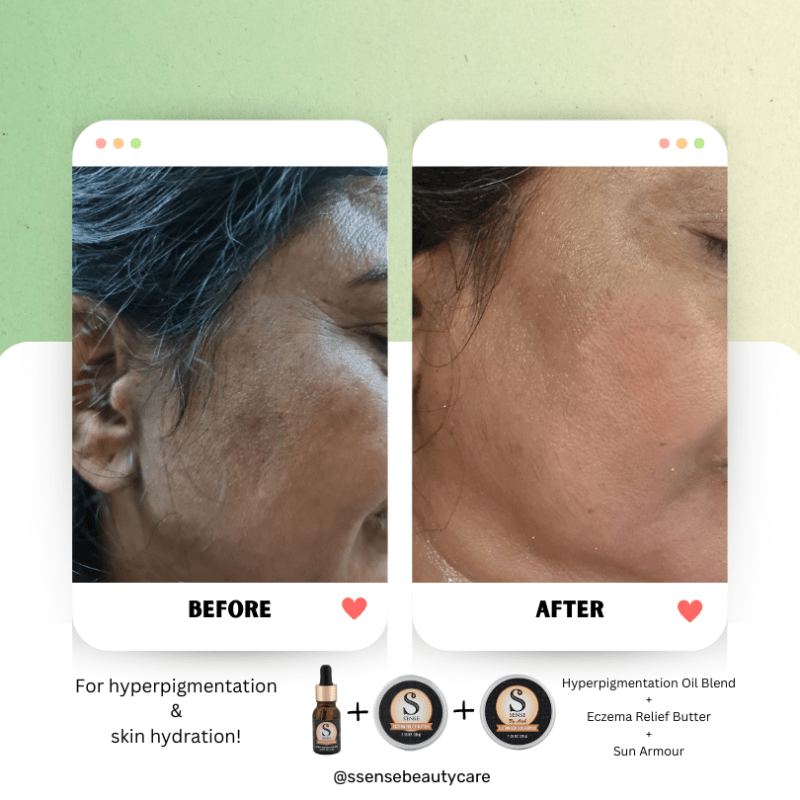 skin - hyperpigmentation (1)